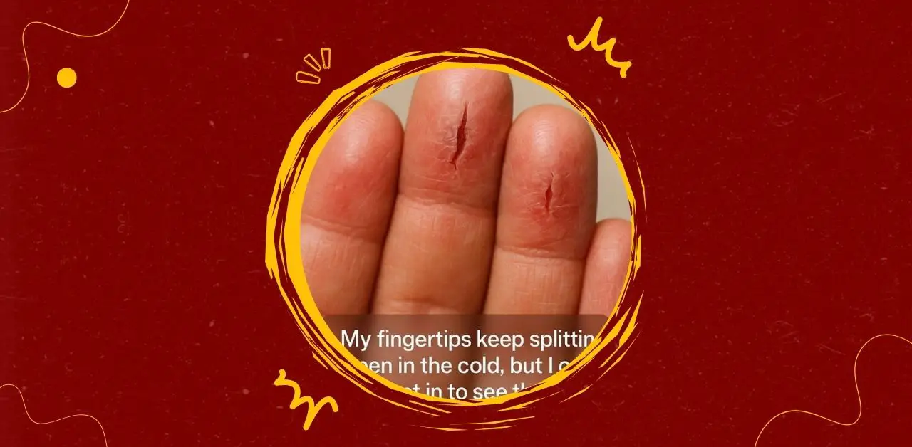 Coping with Cracked Fingertips in Cold Weather