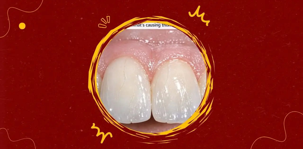 Fine Cracks in Teeth Causes, Concerns, and Care