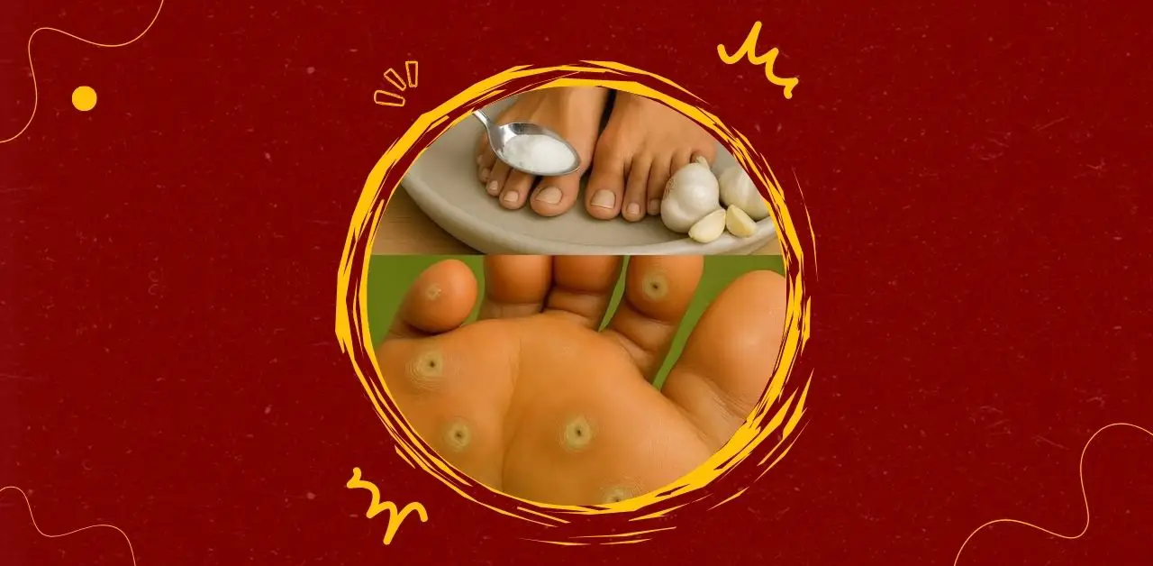Plantar Warts and Natural Remedies Garlic, Salt, and Beyond