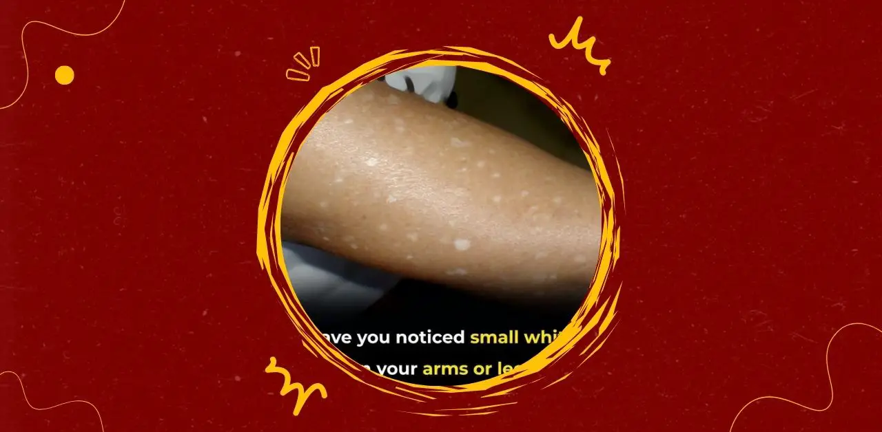 Small White Spots on Arms and Legs You Need To Know