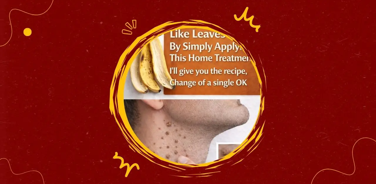 Banana Peel Wart Care Remedy