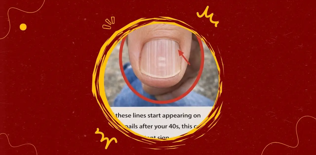 Vertical Ridges on Nails What They Mean After 40