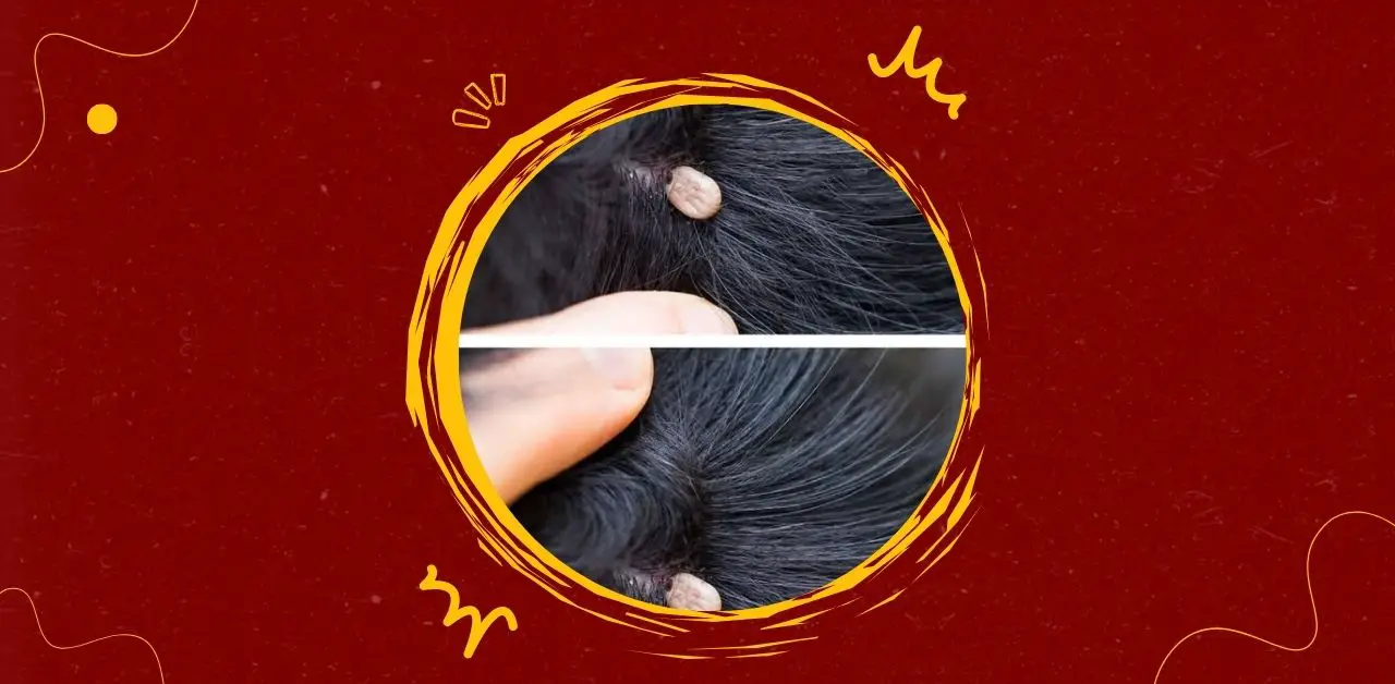 Tick Bites on the Scalp What You Need to Know