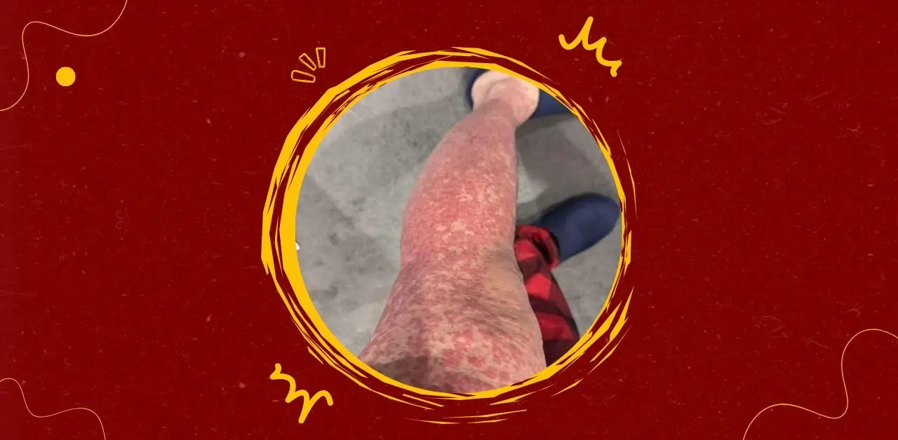 Red, Inflamed, Patchy Skin on the Legs You Need To Know