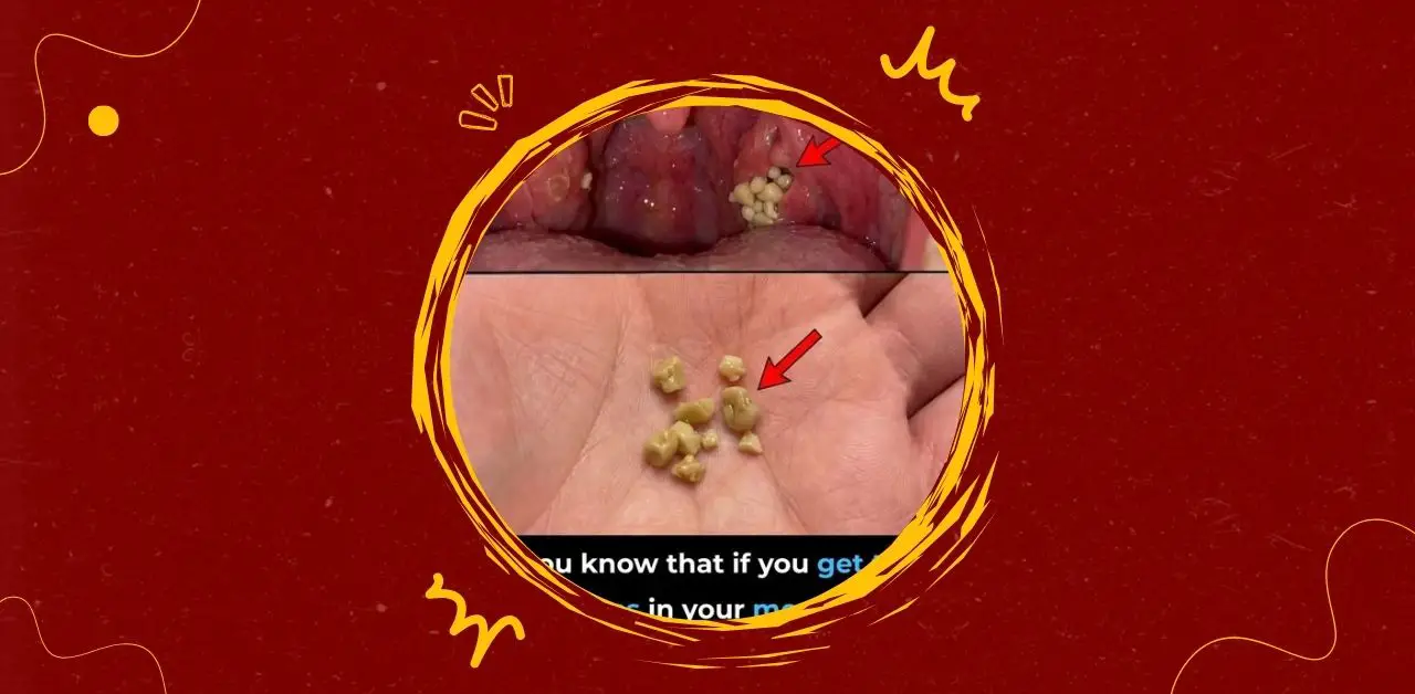 Tonsil Stones Causes, Symptoms, and Care