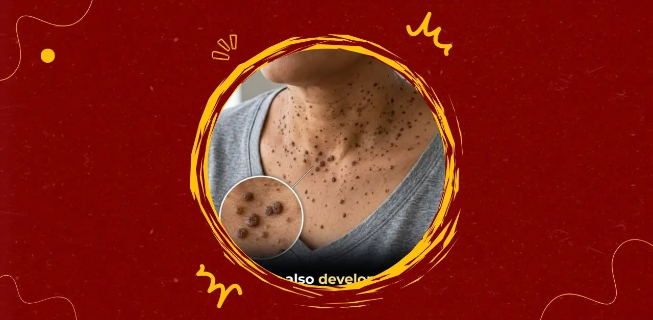 Understanding Skin Bumps on the Neck You Need To Know