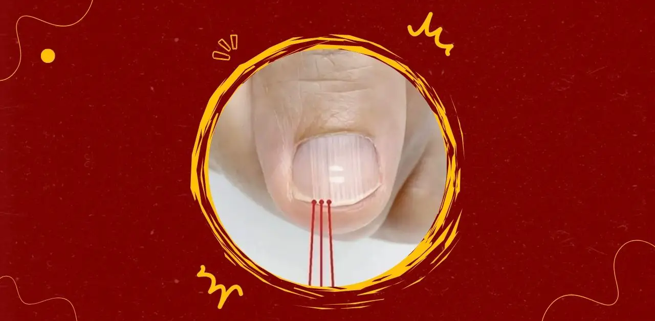 Vertical Nail Ridges Causes, Meaning, and Care