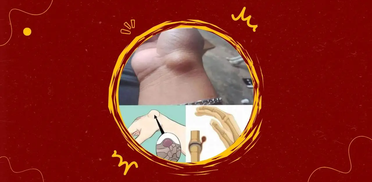 Ganglion Cysts Causes, Symptoms, and Safe Treatment Options