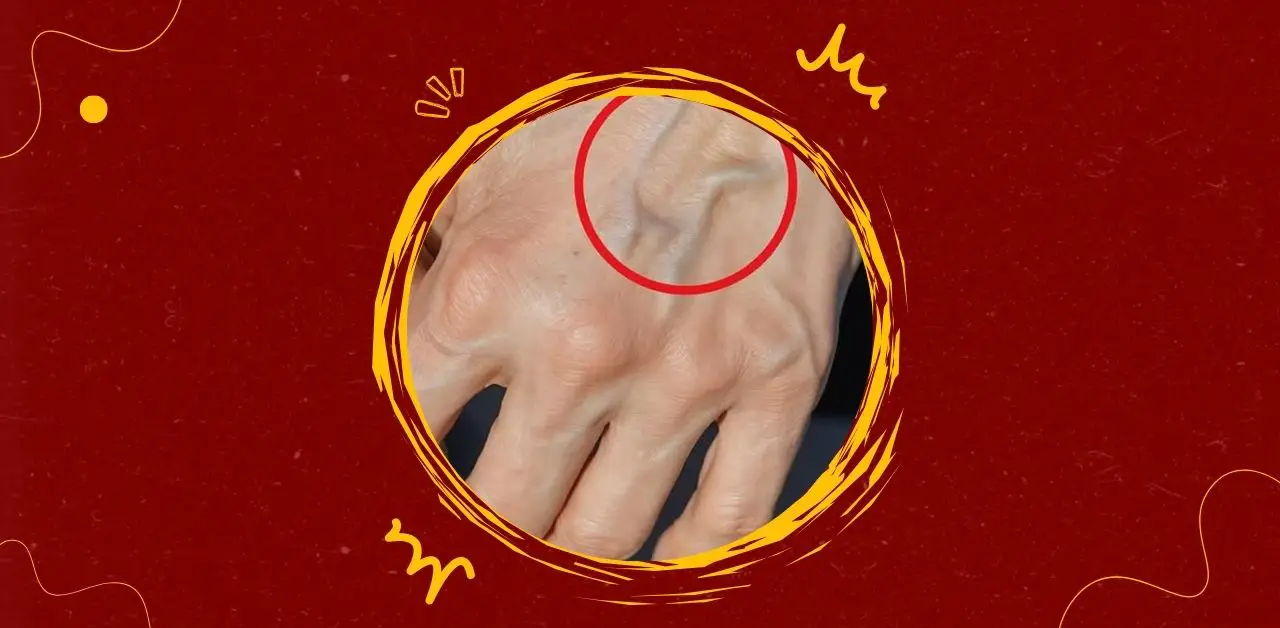 Veins and Skin Changes on the Hands