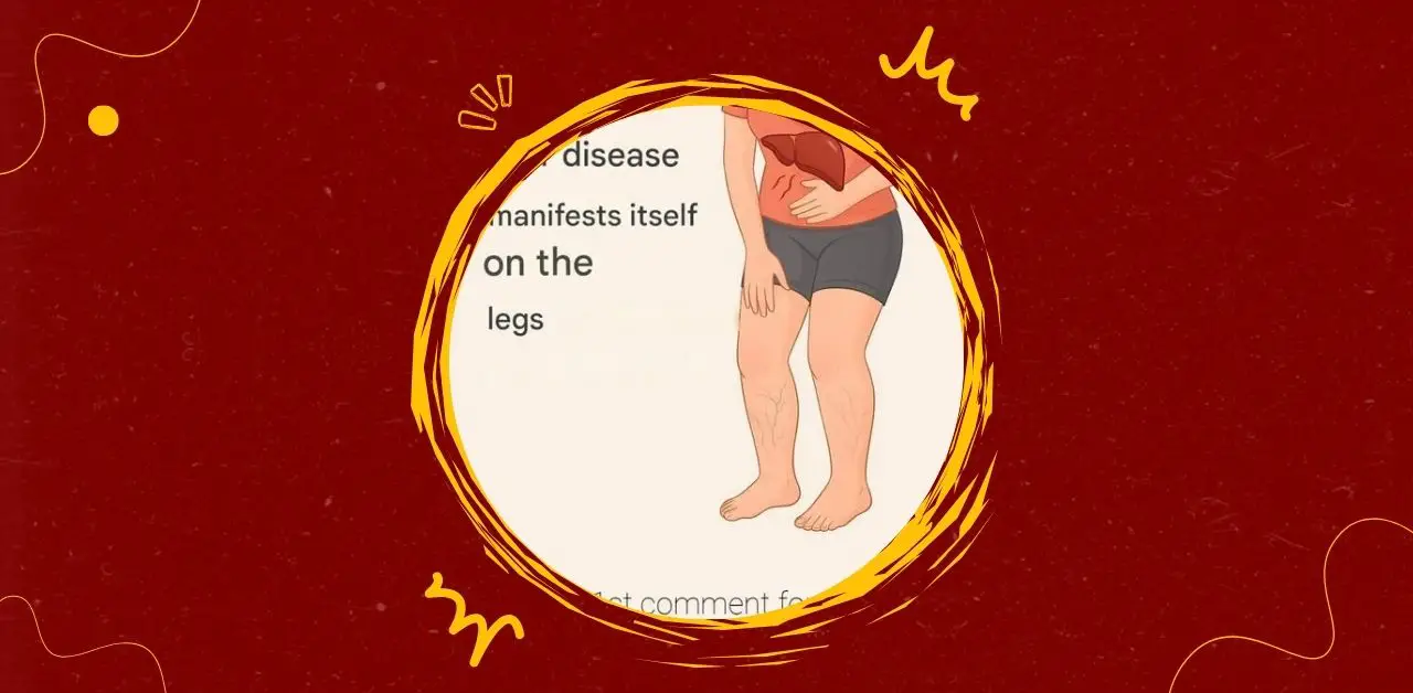 How Liver Disease Manifests in the Legs