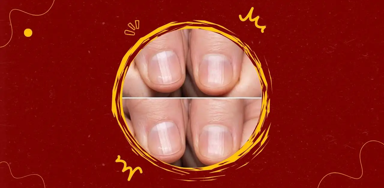 Vertical Ridges on Fingernails You Need To Know