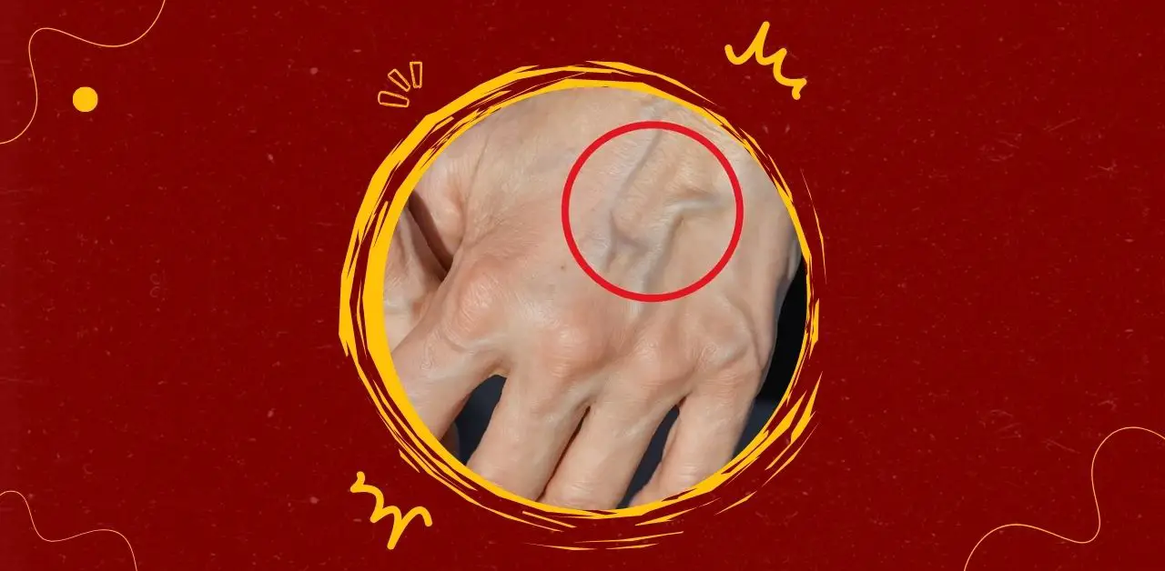 Prominent Veins on Hands What They Mean