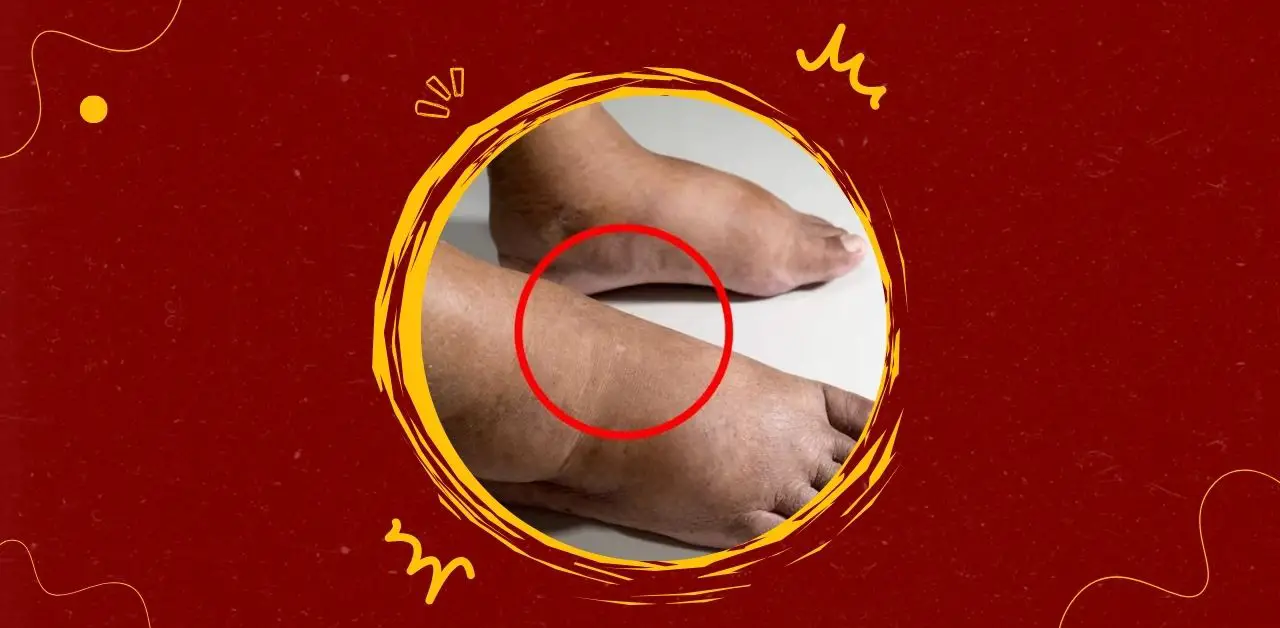 The Consequences of Sleeping with Swollen Feet and Ankles