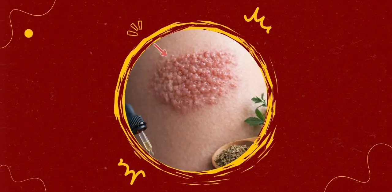 Natural Approaches to Skin Comfort