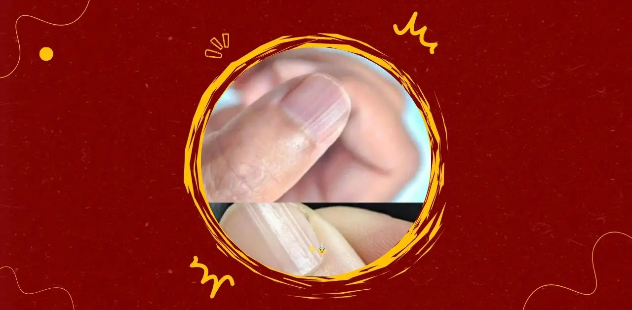 Vertical Ridges on Fingernails Causes, Care and When to Seek Help