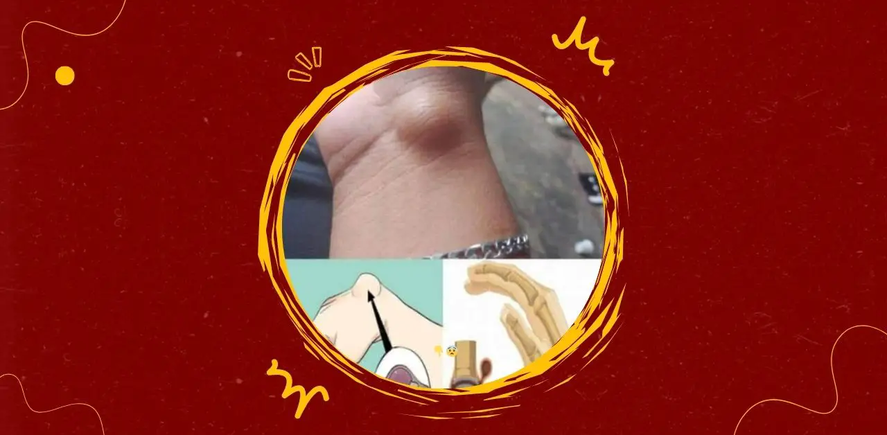 Ganglion Cysts of the Wrist Causes Symptoms and Treatment Options