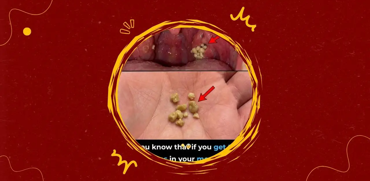 Tonsil Stones Causes Symptoms and What They Mean