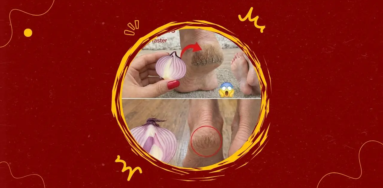 Natural Onion Heel Softening Remedy