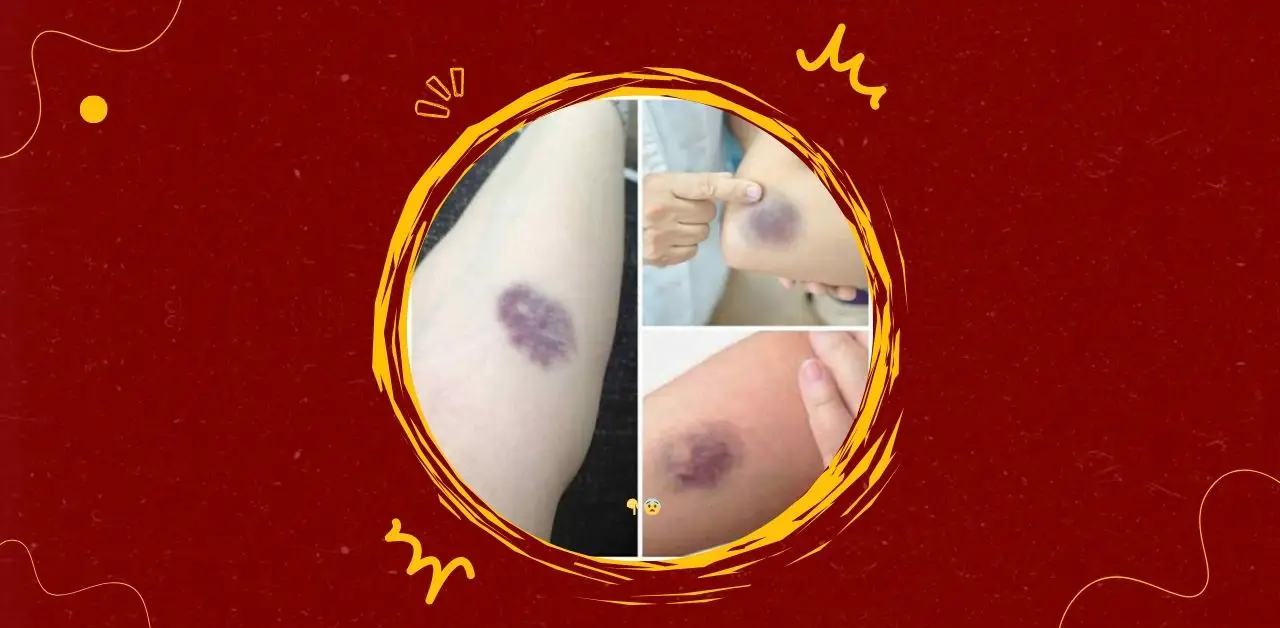 Understanding Bruises Causes Risks and Care