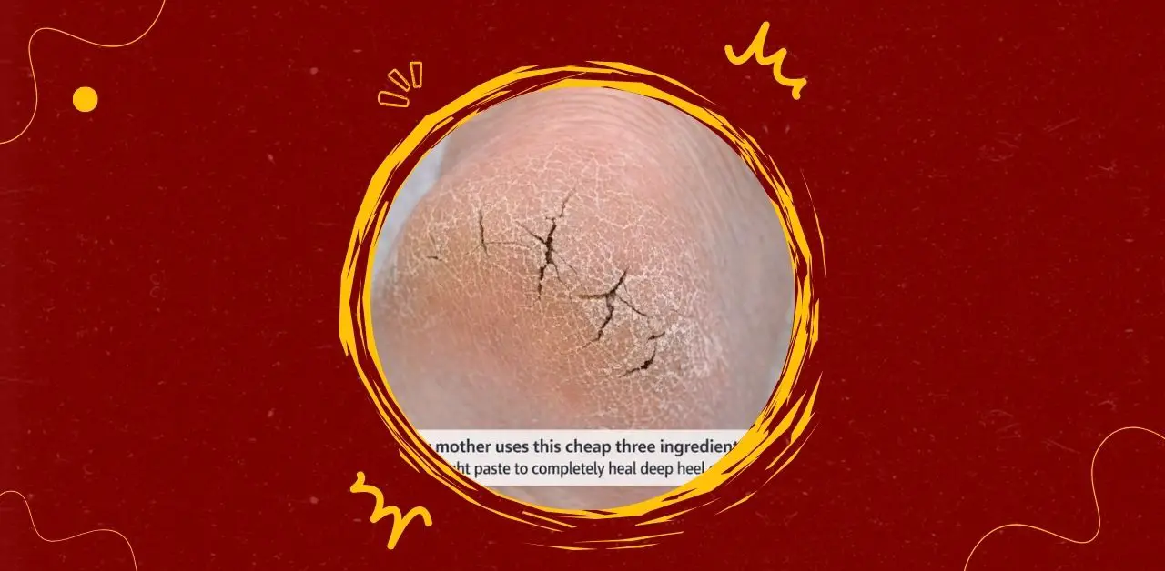 Three‑Ingredient Overnight Heel Healing Paste