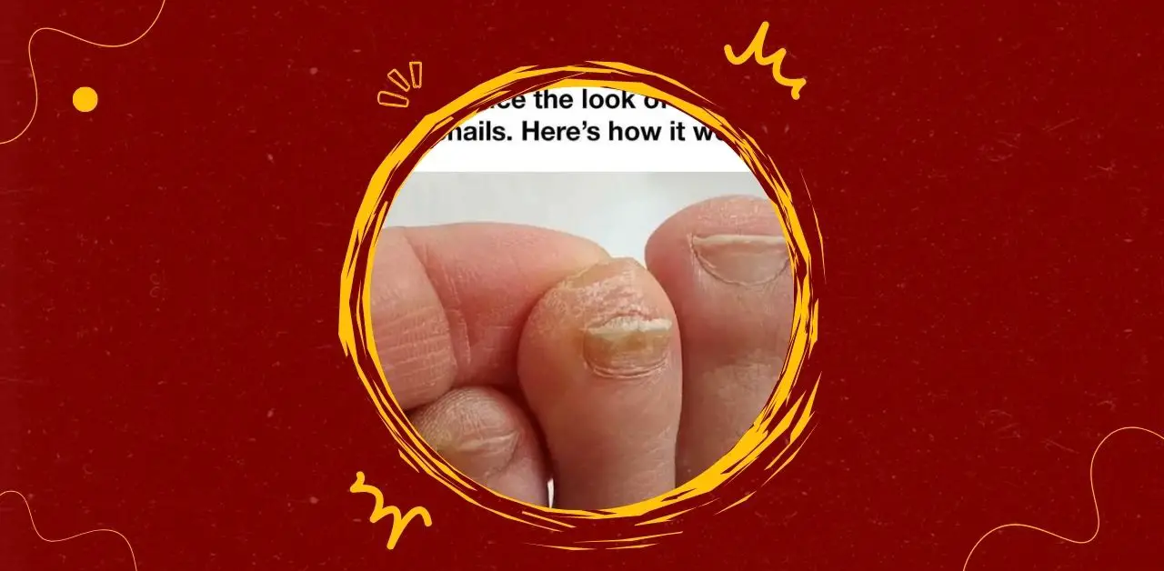 The Simple Trick to Improve the Appearance of Thick Toenails