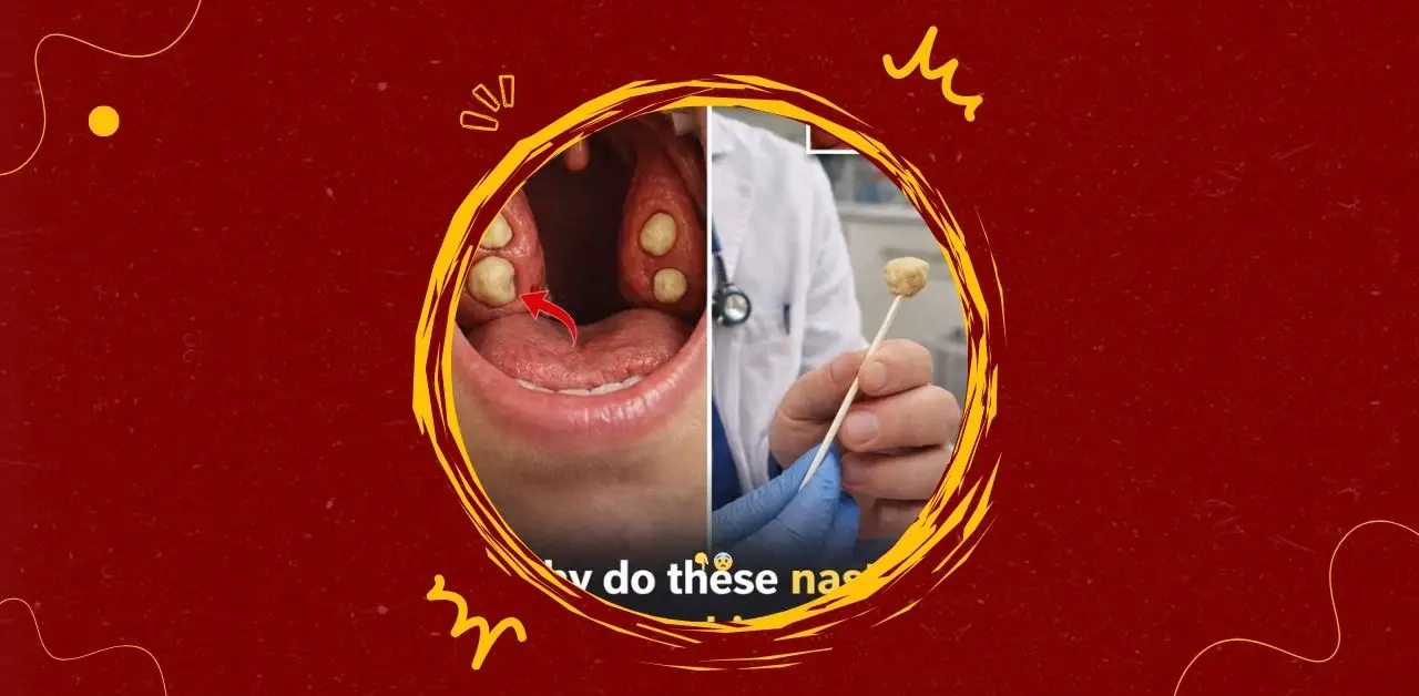 Tonsil Stones Causes Symptoms and Remedies