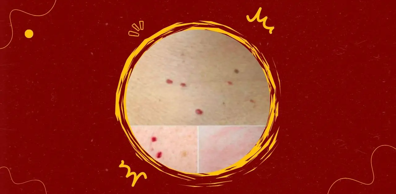 Red Spots on Skin Causes and Care You Need To Know