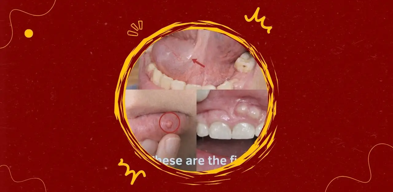 Early Symptoms of Oral Cancer What to Watch For