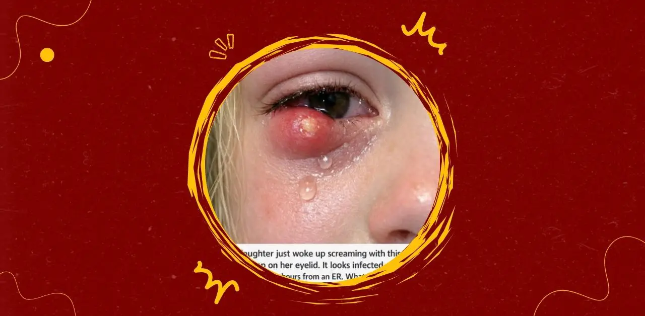 Swollen Eyelids in Children You Need To Know