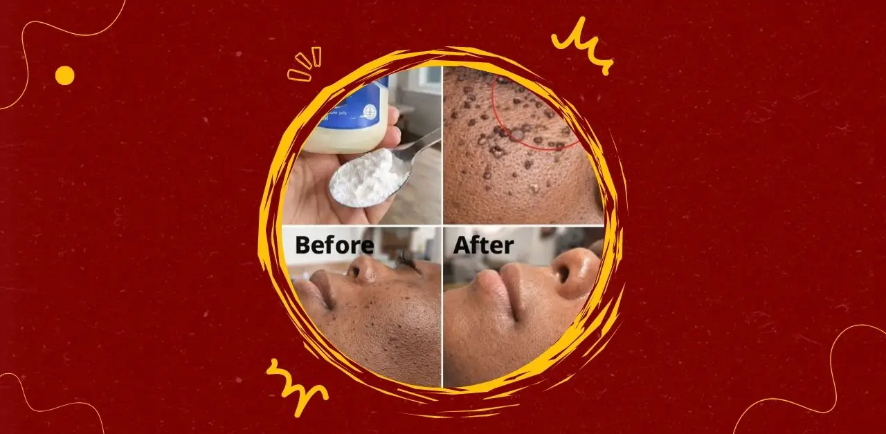 Gentle Skin Tag Removal Balm Recipe