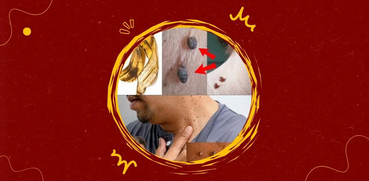 Natural Ways to Remove Skin Tags at Home