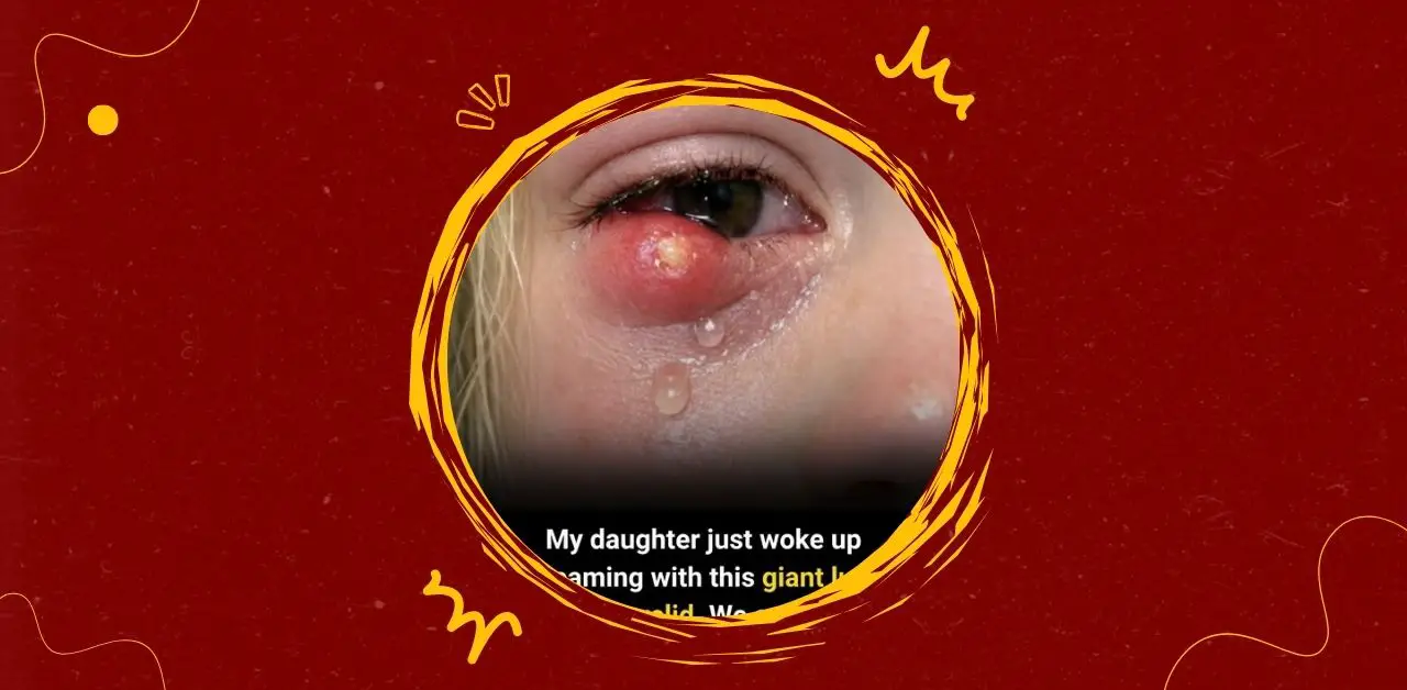 Understanding Eyelid Lumps in Children